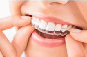 Advantages of clear aligners